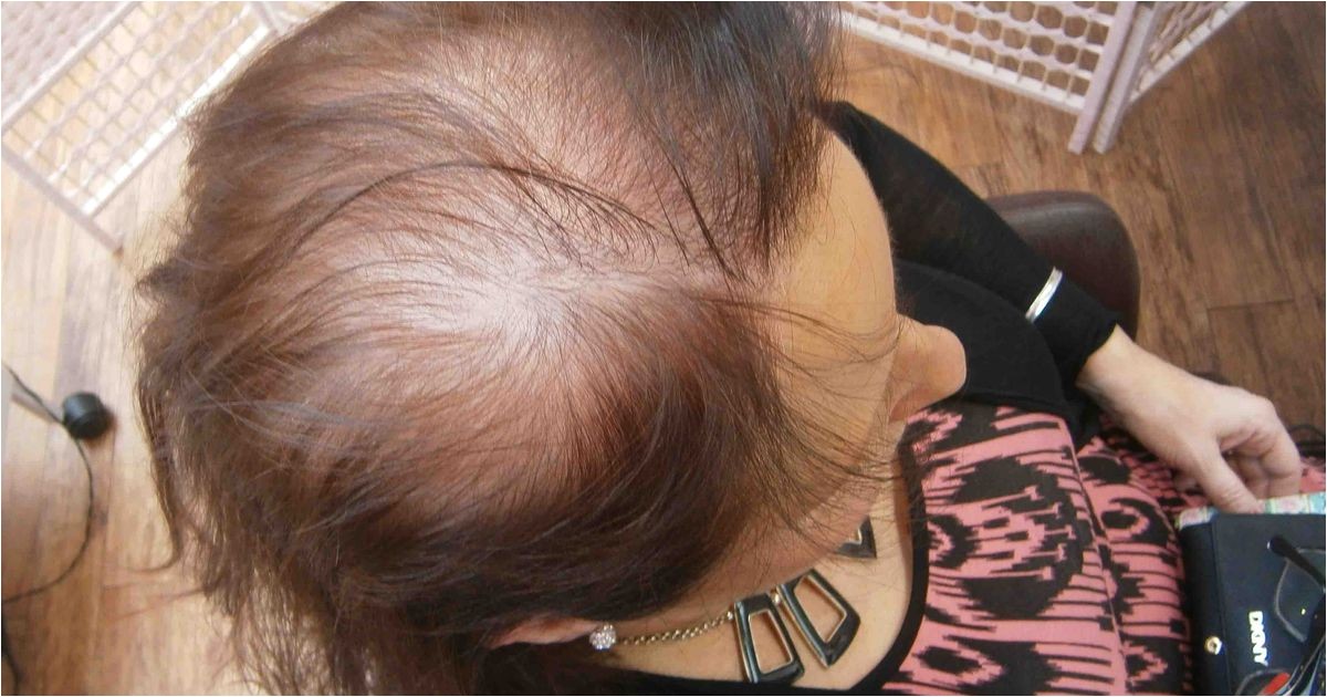 Thinning locks and bald patches the hidden horrors of female hair loss and how to fix it Mirror line