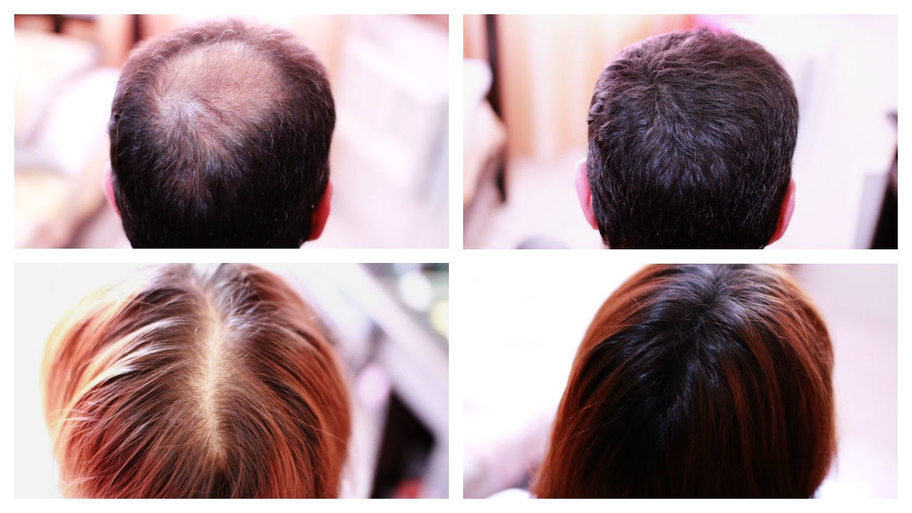How to Cover Up Hair Loss Bald Spots Thinning Hair Receding Hairline Effectively A MUST SEE